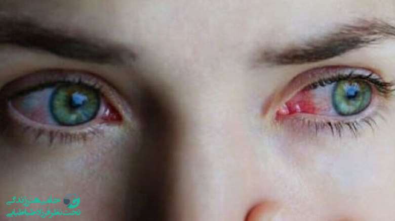 چشمان افراد افسرده | مهمترین تاثیرات ناشی از افسردگی بر چشم